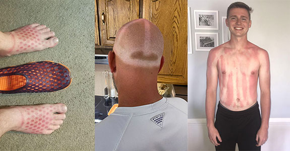 See what happened to those who thought they didn't need sunscreen. (50 new images)
